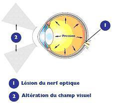 glaucome