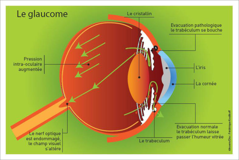glaucome
